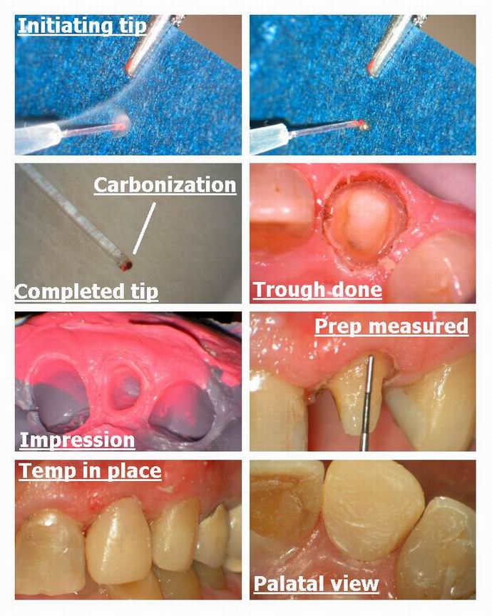 Resize of Crown prep Collage pg 3.jpg